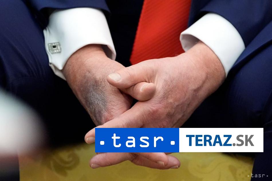 Trumpove modriny na rukach vyvolavaju obavy o zdravie